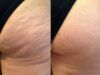 La celulitis afecta hasta al 90% de las mujeres La celulitis afecta hasta al 90% de las mujeres - Fórmula Entretenimiento
