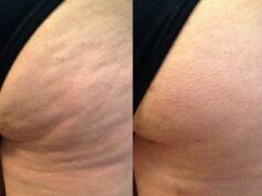 La celulitis afecta hasta al 90% de las mujeres La celulitis afecta hasta al 90% de las mujeres - Fórmula Entretenimiento