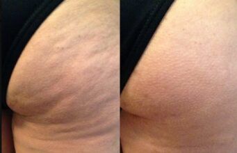 La celulitis afecta hasta al 90% de las mujeres La celulitis afecta hasta al 90% de las mujeres - Fórmula Entretenimiento