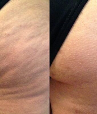 La celulitis afecta hasta al 90% de las mujeres La celulitis afecta hasta al 90% de las mujeres - Fórmula Entretenimiento