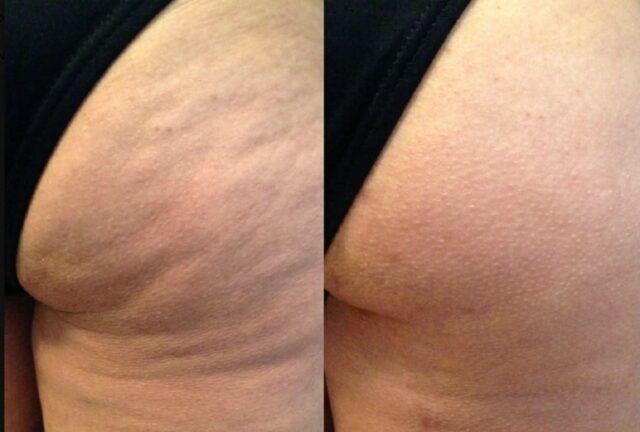 La celulitis afecta hasta al 90% de las mujeres - Fórmula Entretenimiento La celulitis afecta hasta al 90% de las mujeres - Fórmula Entretenimiento